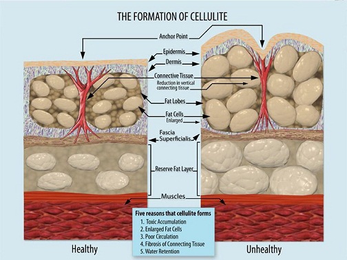 formation de la cellulite